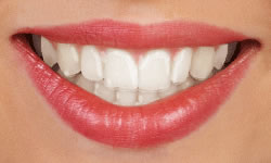 Clear Aligner