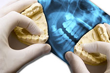 Corrective Jaw Surgery molds