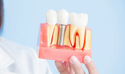 Implant Model