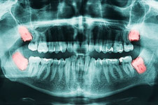 Wisdom Teeth X-Ray
